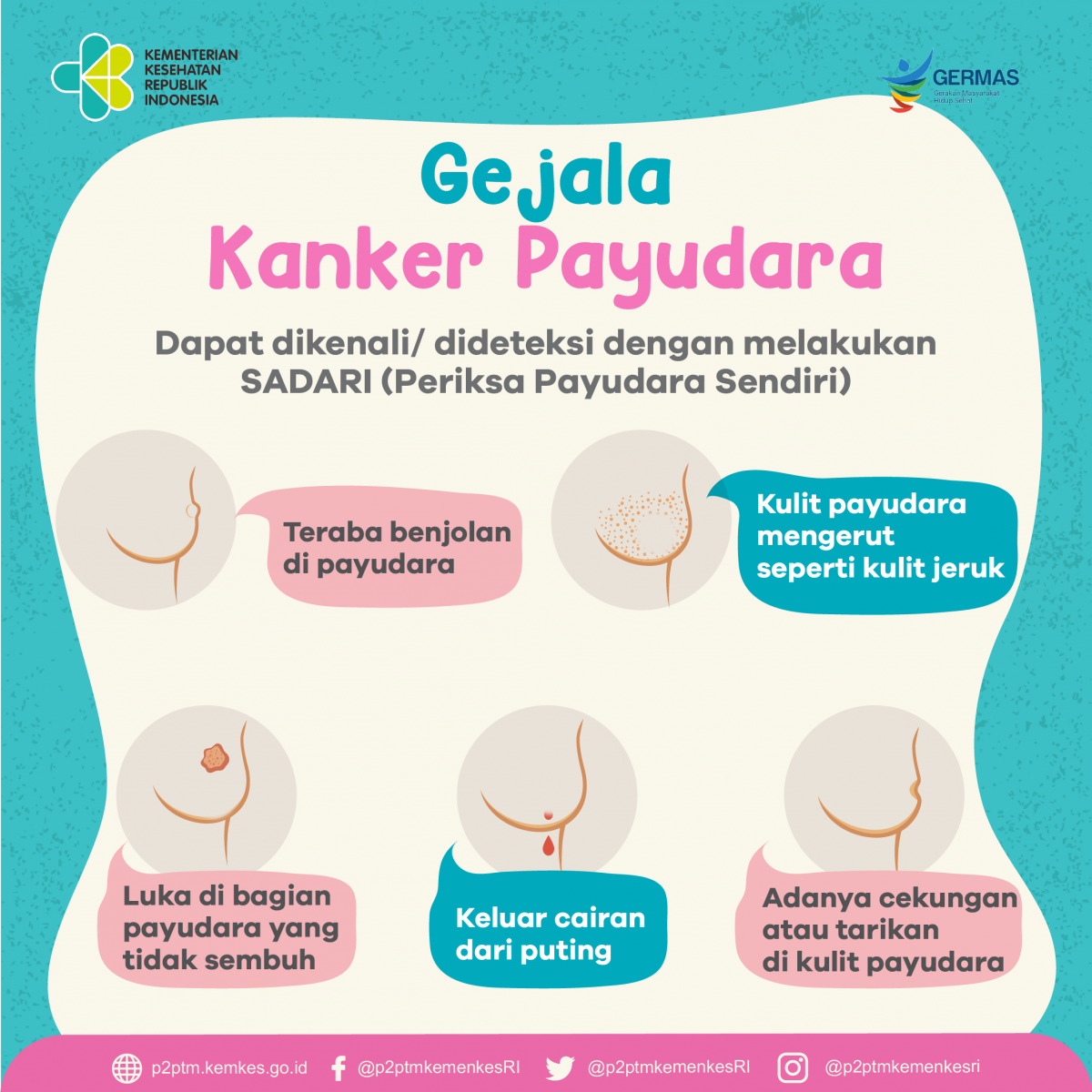 Kenali Gejala Kanker Payudara Dan Deteksi Kapan Anda Harus Ke Dokter